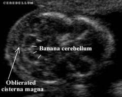 Posterior fossa obliterated by hernation of cerebellum
Cerebellum is banana shaped
Lemon Head Sign of skull
Ventriculomegaly – progresses during pregnancy
Head size small to normal
Neural Tube Defect of spine

http://www.youtube.com/watch...
