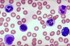 The large cells with big nuclei in the above image of blood are known as what?
A- Erythrocytes
B- Thrombocytes
C- Leukocytes
D- Red blood cells