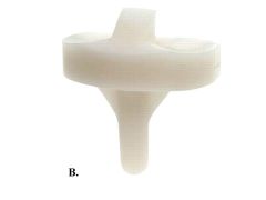 Adding a polyethylene-metal interface by making it modular leads to more wear on the backside, not the articular surface, Modularity with metal tibial base plates has the advantage of being able to customize implants intraoperatively. However, a d...