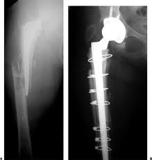 Vancouver classification of periprosthetic femur fractures is based on the fracture site, implant stability, and remaining bone stock. The patient in the question has a type B3 fracture. The cemented stem is loose and there is very poor remaining ...