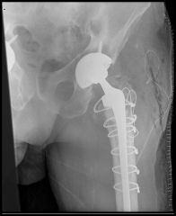 The long spiral fracture is consistent with a loose implant. The bone stock is sufficient. Therefore, this fracture pattern would classify as a B2 using the Vancouver classification system. The Vancouver classification for periprosthetic femoral f...