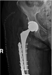 The patient in the scenario has well-fixed femoral and acetabular components with a fracture at the level of the implant extending to tip. This corresponds to a Vancouver B1 fracture. Treatment for B1 fractures is open or closed reduction, followe...
