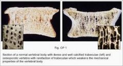 Osteopenia has what effect on the strength of the bone-cement interface in comparison to normal bone? 1-no effect; 2-improved mechanical integrity (higher fracture resistance); 3-diminished mechanical integrity (low fracture resistance); 4-reduced...