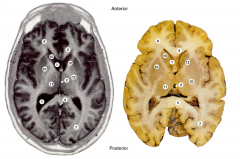 Identify structures in the brain (axial)