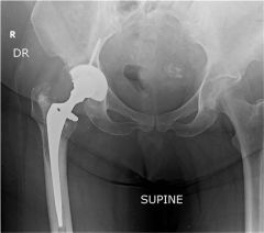 All of the following are independent risk factors for dislocation after total hip arthroplasty EXCEPT?  1-Female gender; 2-Osteonecrosis; 3-Inflammatory arthritis; 4-Post traumatic OA; 5-Age >70