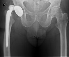 pts at > risk are female pts (relative risk 2.1), those with a dx of osteonecrosis of the femoral head (relative risk 1.9), an acute fx or nonunion proximal fem treated with THA (relative risk 1.8), hx of inflammatory arthritis (relative risk 1.5)...