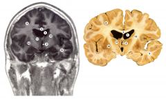 Identify structures in the brain (Coronal)