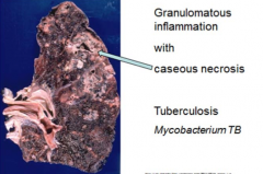 -in central portion of lesion


-cheesy-like appearance


-characteristic of TB infection