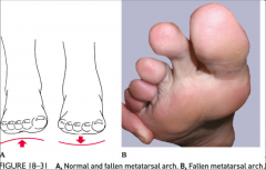 -pain in the foot between 2nd and 3rd metatarsal head
-lowered transverse arch