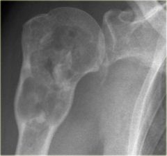 A 53-year old female presents to your community hospital with right shoulder pain of 2 weeks duration, night sweats, and loss of appetite. Her past medical history is significant for hypertension only. A radiograph is performed and is shown in Fig...