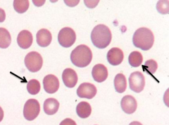 - Spherocytes (round, small diameter, more densely staining, lack of central pallor)
- Eg, hereditary spherocytosis, autoimmune hemolytic anemia