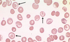 - Target Cells (too much surface area for amount of cytoplasm
- Eg, liver disease, splenectomy, and hemoglobinopathies
