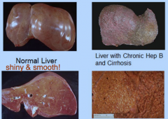 -virus that infects hepatocytes of liver


-tissue run is chronic inflammation


-may result in cirrhosis - formation bumpy nodules on liver due to fibrosis