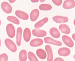- Ellipotocytes (or ovalocytes)
- Eg, hereditary ellipotocytosis, megaloblastic anemia, iron deficiency, myelofibrosis