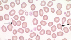 - Teardrop Cells
- Megaloblastic anemia, myelofibrosis, extramedullary hematopoiesis