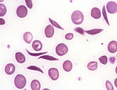 - Sickled Cells
- Caused by sickle cell disease