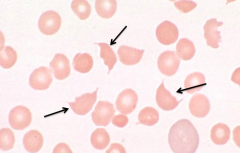 - Schistocytes / RBC fragments
- Eg, TTP (Thrombotic thrombocytopenic purpura), DIC, malignant HTN