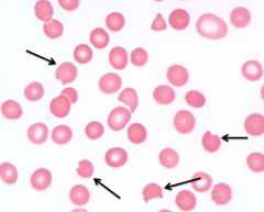 - "Bite Cells"
- Eg, oxidant hemolysis (G6PD deficiency)