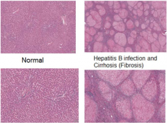 -Normal: homogenous


-Abnormal: many pink nodules (of hepatocytes), varying sizes, separated by bands of purple cells (area of fibrosis & chronic inflammation of  mononuclear cells)


other stain will stain blue in bands - collagen

 


 