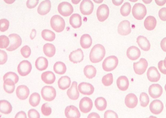 Hypochromic RBCs (central pallor >1/3 diameter)
- Iron deficiency
- Thalassemia trait
- Sideroblastic anemia
- (Anemia of chronic disease)