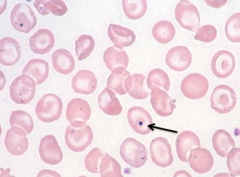- Howell-Jolly Bodies (nuclear fragments)
- Eg, Splenectomy, megaloblastic anemia