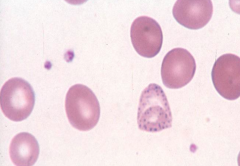 Basophilic Stippling (coarse)
- Disordered hemoglobin synthesis