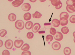 - Hemoglobin C crystals
- Eg, Hb CC disease, Hb SC disease