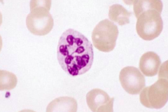 - Hypersegmented neutrophil
- Eg, megaloblastic anemia