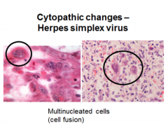 -different than CMV- causes multinucleated cells!
