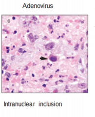 Intranuclear inclusion