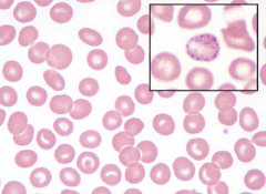- Mild or no anemia (Hb>~10g)
- Microcytosis (50-70 fL)
- Mild anisopoikilocytosis w/ scattered target cells
- Basophilic stippling
- Elevated HbA2: 3.5-7%
