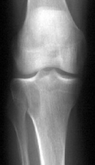 A 50-year-old female presents to your office with worsening knee pain of 6 months duration. Radiographs are shown in Figure A and B. She is otherwise healthy and very active. She insists that something be done today to treat her symptoms. Your ini...