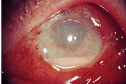 symptoms include eye ache/pain, decrease in vision/visual acuity. chemosis (conjunctival edema), hypopyon. Diagnose by culturing aqueous/vitreous humor. Give antibiotic injections into vitreous. 