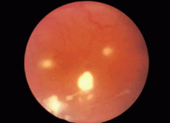 Any candidemic patient should have a dilated ophtho exam. Up to 6% of fungemic patients will develop endophthalmitis. Patients will have focal white infiltrative lesion described as fluffballs. Start patients on intravitreal and IV antifungals. 