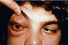 Both can have swollen shut lids with fever and increased WBCs.


Pre-septal: anterior to orbital septum, visual acuity is normal, extra-ocular movements are full, no pain on eye movement, no proptosis.


Orbital (pic): porsterior to orbital se...