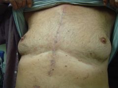 Name the scar and its significance in CV exam