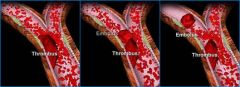 Fragment of thrombi detaches from vessel wall


Embolus travels through vessels, until in reaches a vessel too small to flow through


Blocks small vessel, forming embolism