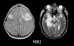 if a patient presented with fever, personality change, and this MRI, what is high on the list? 