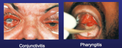 Pharyngitis: often asymptomatic, non-exudative, but may see erythema


Conjunctivitis: pain, erythema, discharge 


Exam: Gram stain discharge


Perirectal: tenesmus, pain, discharge,


Exam: friable mucosa w/ discharge


 