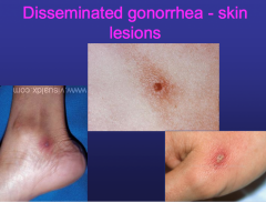 -result of gonococcal bacteremia


-may present as:


Dermatitis-Arthritis Syndrome:
Septic Monoarticular Arthriris: 

​-culture all exposure sites


-Treat w/ IV cetriaxone intially


-change ot oral therapy after 7-10 days