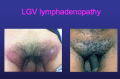 -caused by L1-L3 serovars of CT


-Endemic in Africa, India, SE Asia, etc


-LGV outbreak in Netherlands - 2004


-*MSM: primary concern


S/S: 


-Inguinal lymphadenopathy


-Proctitis  (rectum lining)


seen in MSM & het women (direct inoculat...