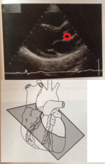 Which cusp of the aortic valve is the circle surrounding?
