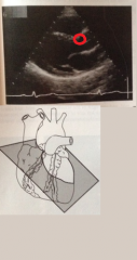 Which cusp of the aortic valve is the circle surrounding?