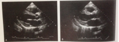 The picture on the left is a PLAX view of the heart during systole or diastole? Why?