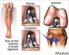 -torn the most often
-will result in secondary injury to other tissues
-occurs due to change of direction, deceleration (knee vlagus/varus, internal/external rotation, anterior knee shear)
-30% due to contact
-women more at risk