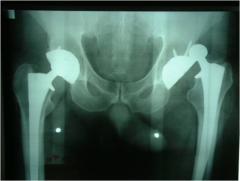 Hx:68yo F 2 wks s/p L THA experiences a painful clunk getting out of bed in the morning, unable to bear any weight on the L leg. xray fig A. Following CR under sedation, the hip continues to dislocate with flexion up to 90 degrees. Each of the fol...