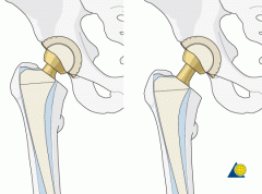 Medializing the acetabulum < the lever arm of the abductors resulting in reduced soft tissue tensioning, greater laxity, and thus < stability, Conversely, stability >following ways: Revising to an extended offset femoral component and advancing th...