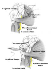 During open pectoralis major tendon transfer for chronic subscapularis deficiency, the musculocutaneous nerve is most at risk. Injury to this nerve would lead to weakness in elbow flexion.

Musculocutaneous nerve neurapraxia is a known complicat...