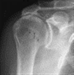 A 75-year-old, right-hand-dominant female has a chronic rotator cuff tear and shoulder pain for 10 years which has failed conservative treatment. A radiograph is shown in Figure A. Your examination and further imaging will help you to decide betwe...