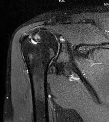 The radiograph shows superior migration of the humeral head with significant glenohumeral degenerative joint disease suggestive of rotator cuff arthropathy. Rotator cuff arthropathy is characterized by bony erosion, superior migration of the humer...